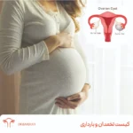 کیست تخمدان و بارداری همزمان