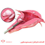 اقدامات لازم قبل از هیستروسکوپی