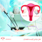 عمل جراحی کیست تخمدان